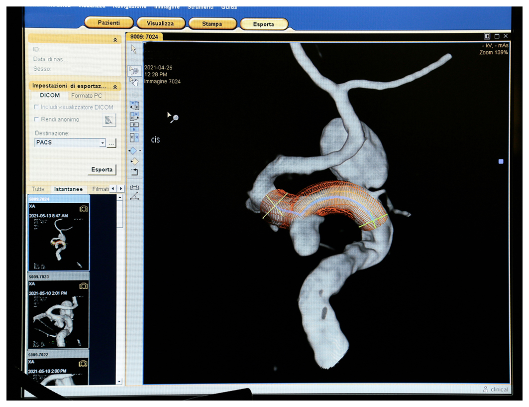 Gli stent impiantati