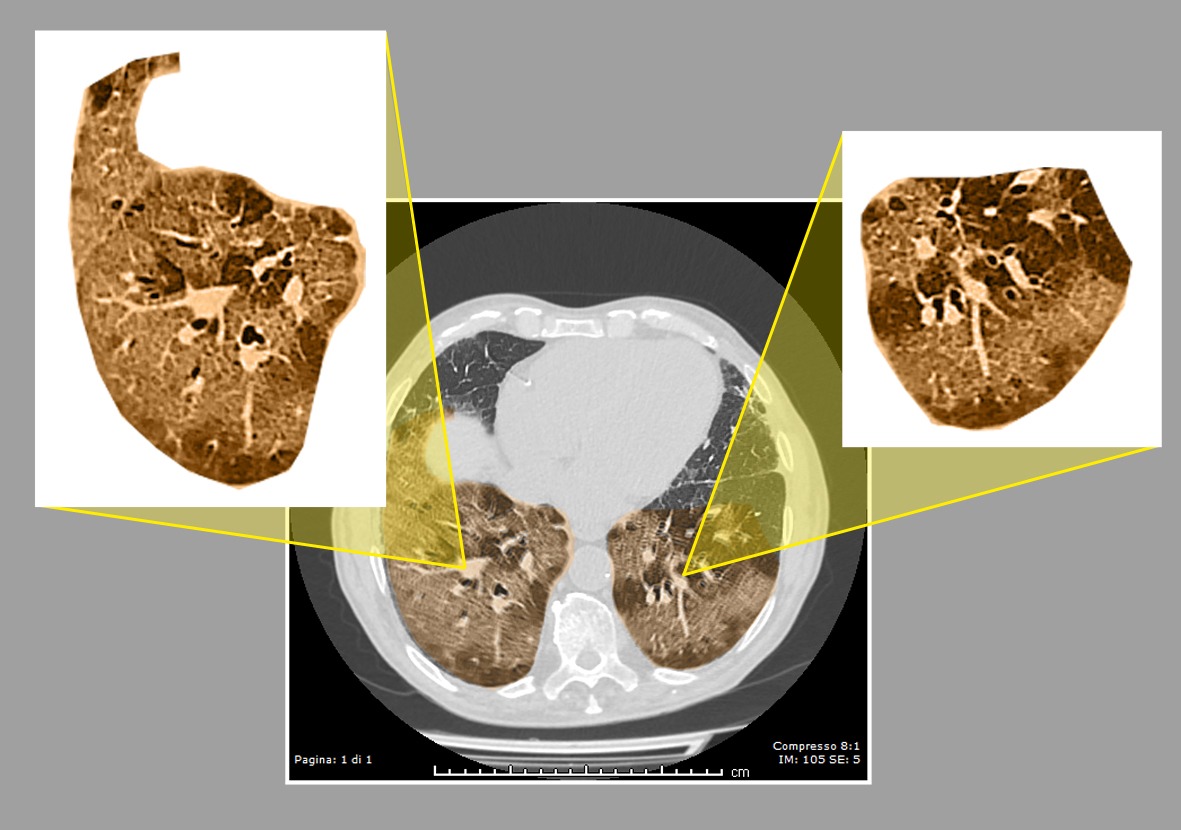 immagini TAC di paziente affetto da polmonite Covid striature bianche nelle parti evidenziate