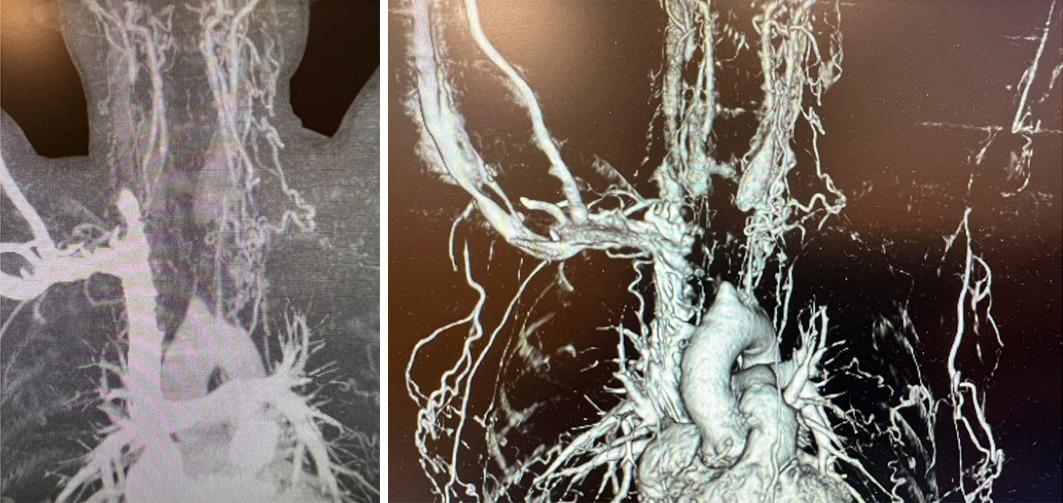 intervento chirurgico vascolare cardiochirurghia arterite 7