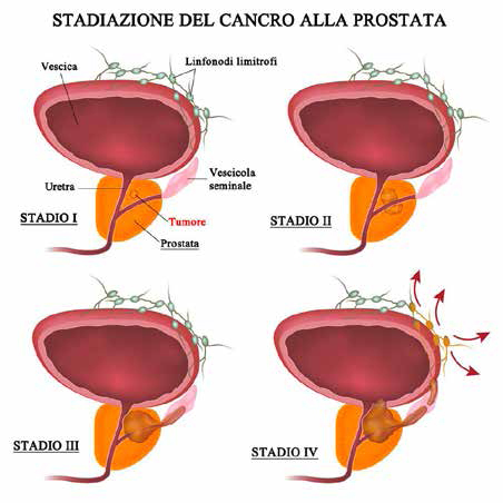 prostata 4